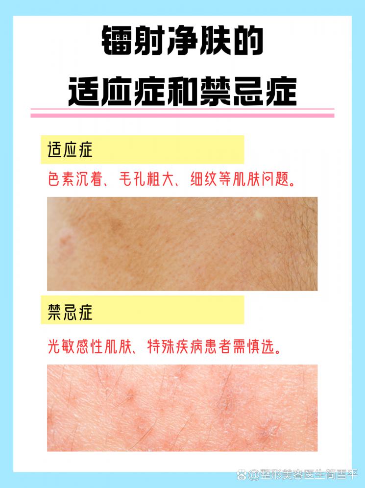 镭射净肤：肌肤焕新，效果全揭秘
