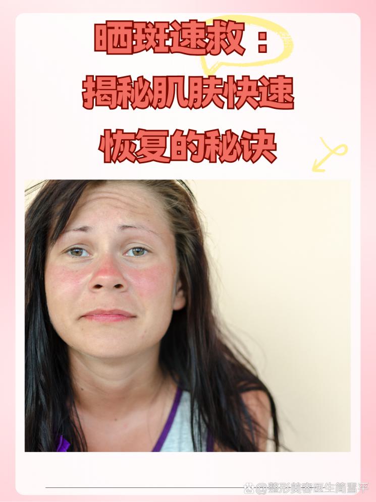 晒斑速救：揭秘肌肤快速恢复的秘诀