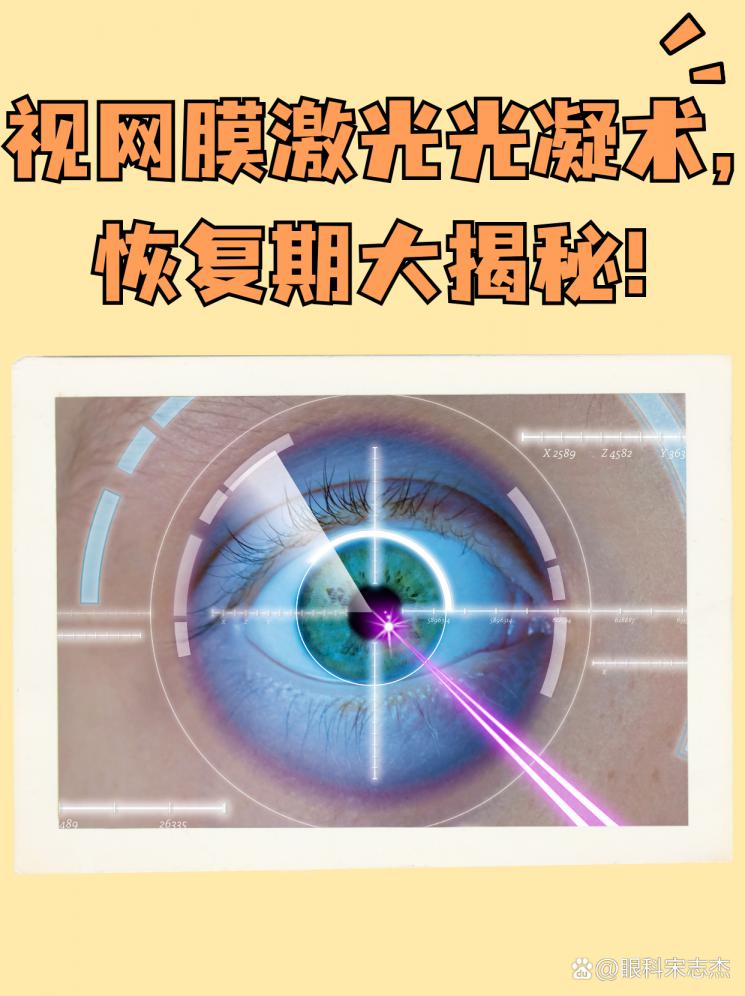 视网膜激光光凝术，恢复期大揭秘！