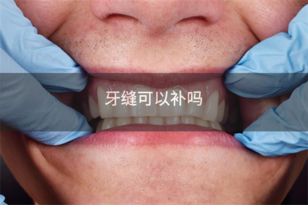 牙缝可以补吗