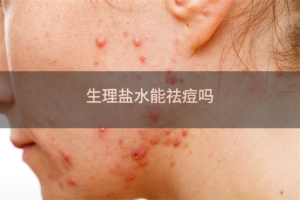 生理盐水能祛痘吗