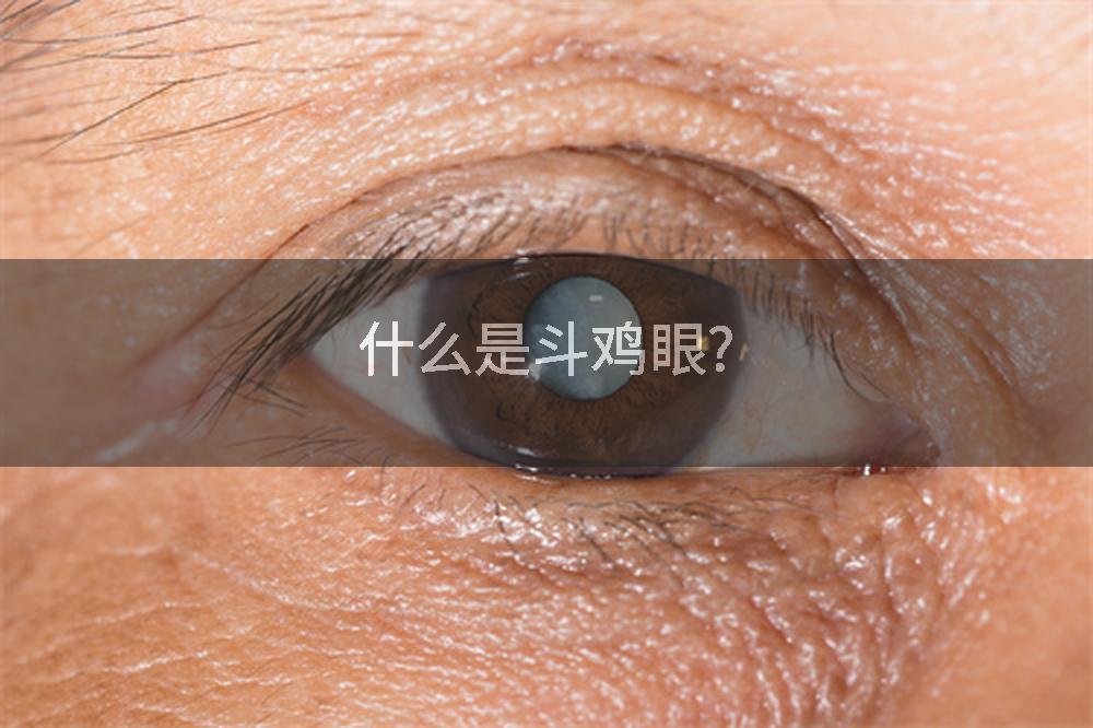 什么是斗鸡眼?