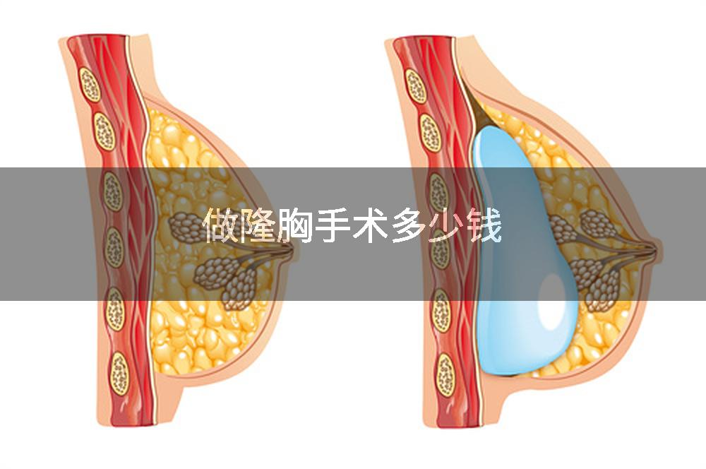 做隆胸手术多少钱