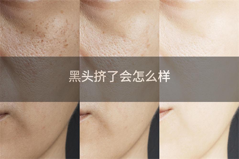 黑头挤了会怎么样