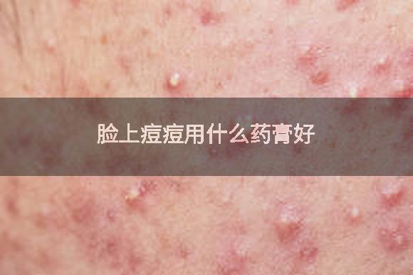 脸上痘痘用什么药膏好