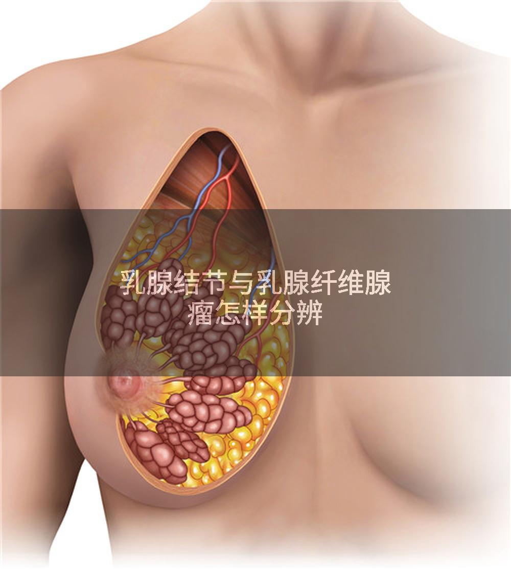 乳腺结节与乳腺纤维腺瘤怎样分辨