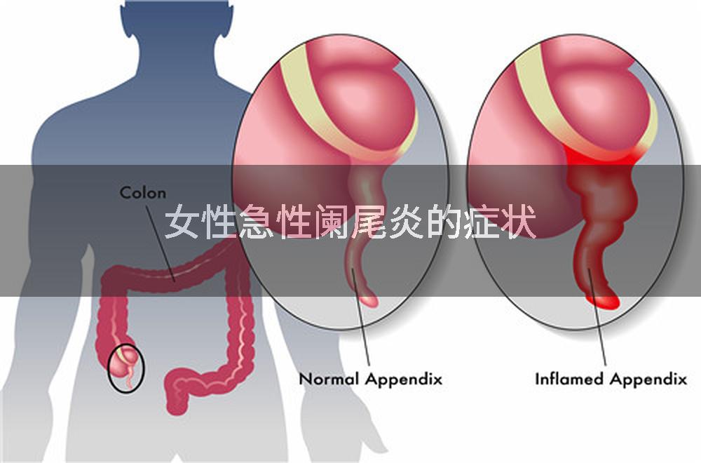 女性急性阑尾炎的症状