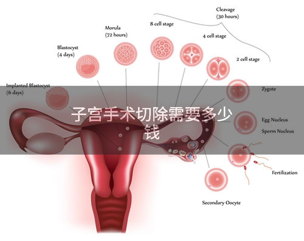 子宫手术切除需要多少钱