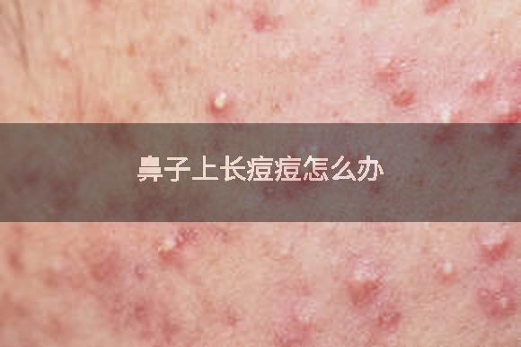 鼻子上长痘痘怎么办