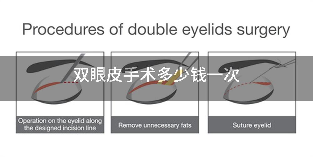 双眼皮手术多少钱一次