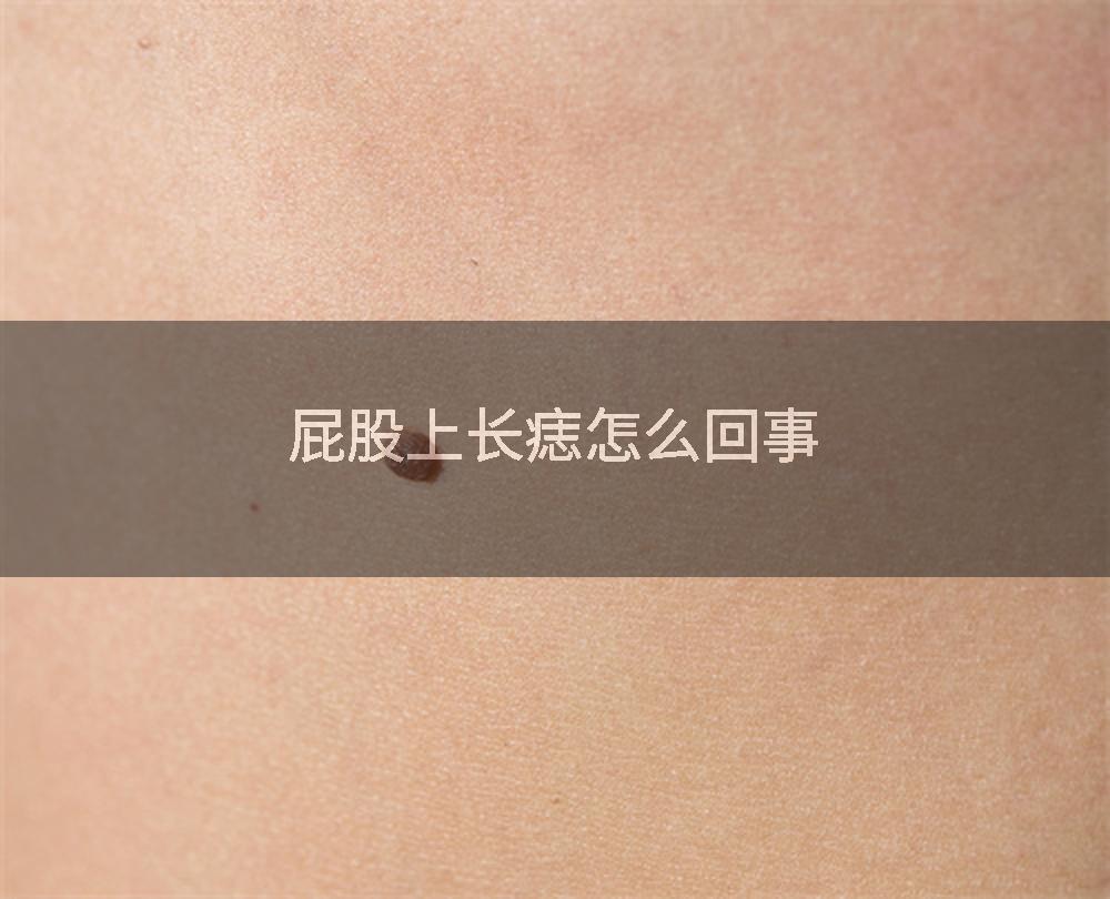 屁股上长痣怎么回事