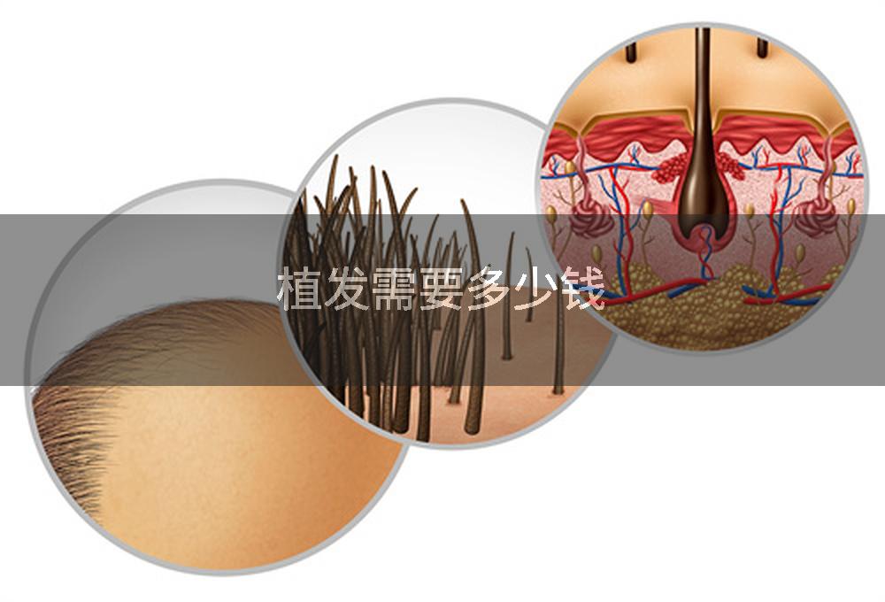 植发需要多少钱