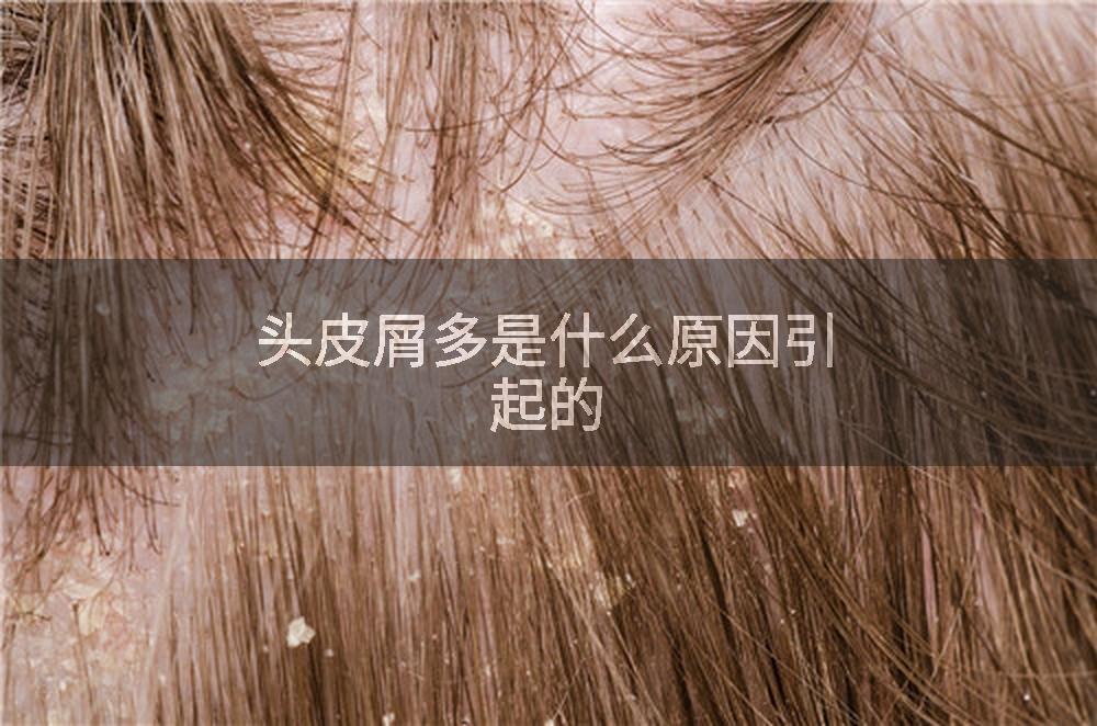 头皮屑多是什么原因引起的