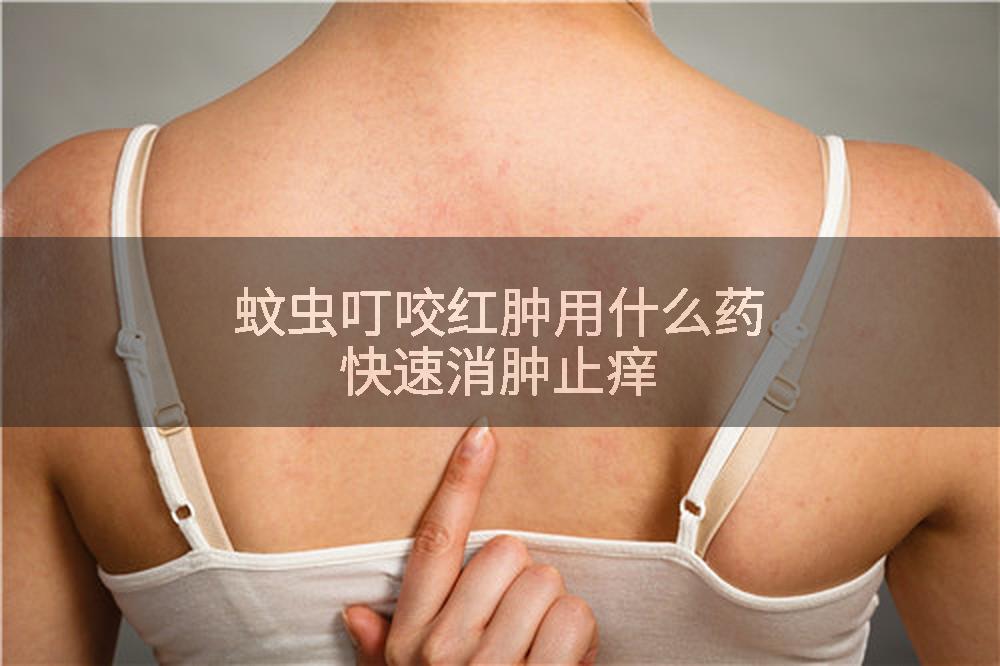 蚊虫叮咬红肿用什么药快速消肿止痒