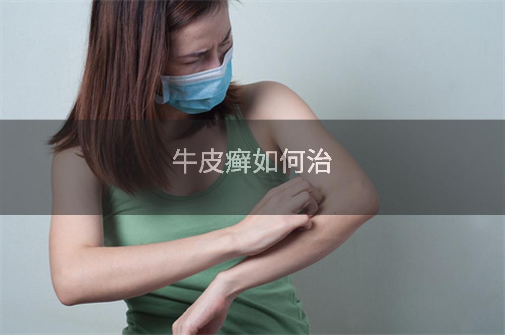 牛皮癣如何治