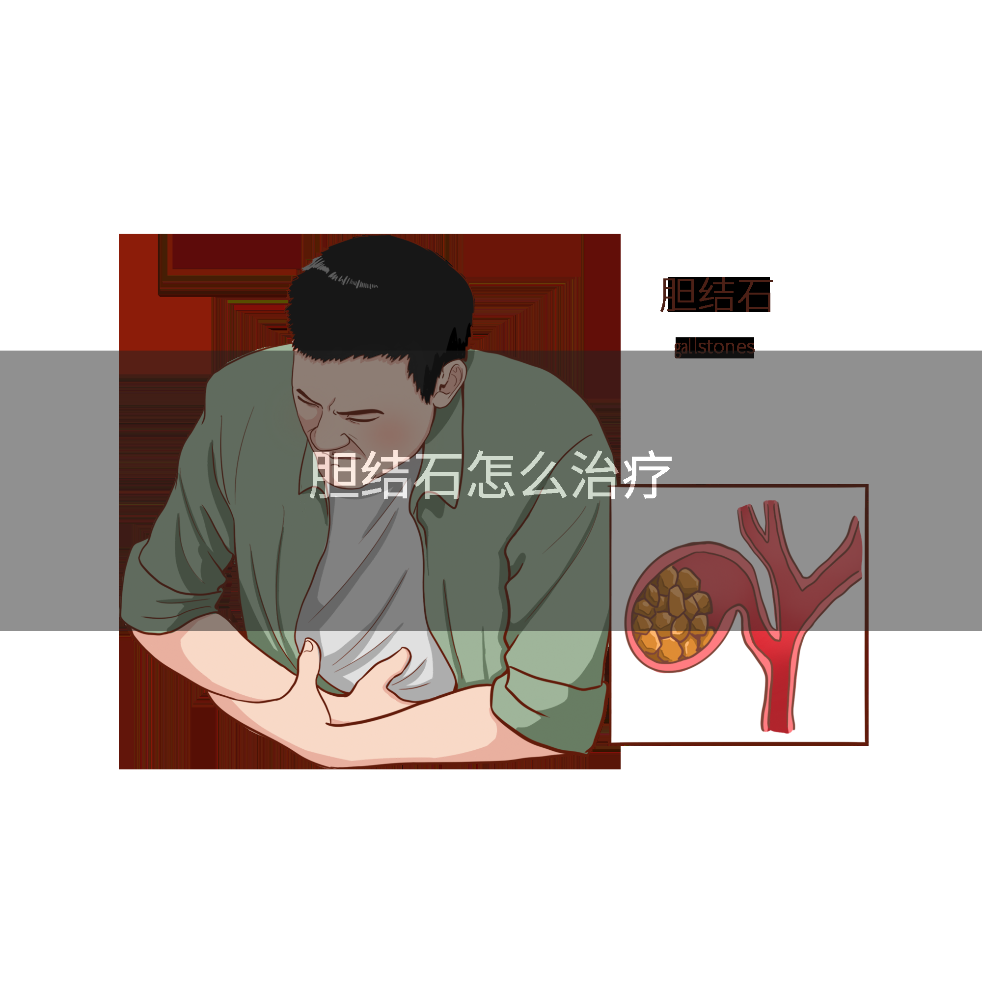 胆结石怎么治疗