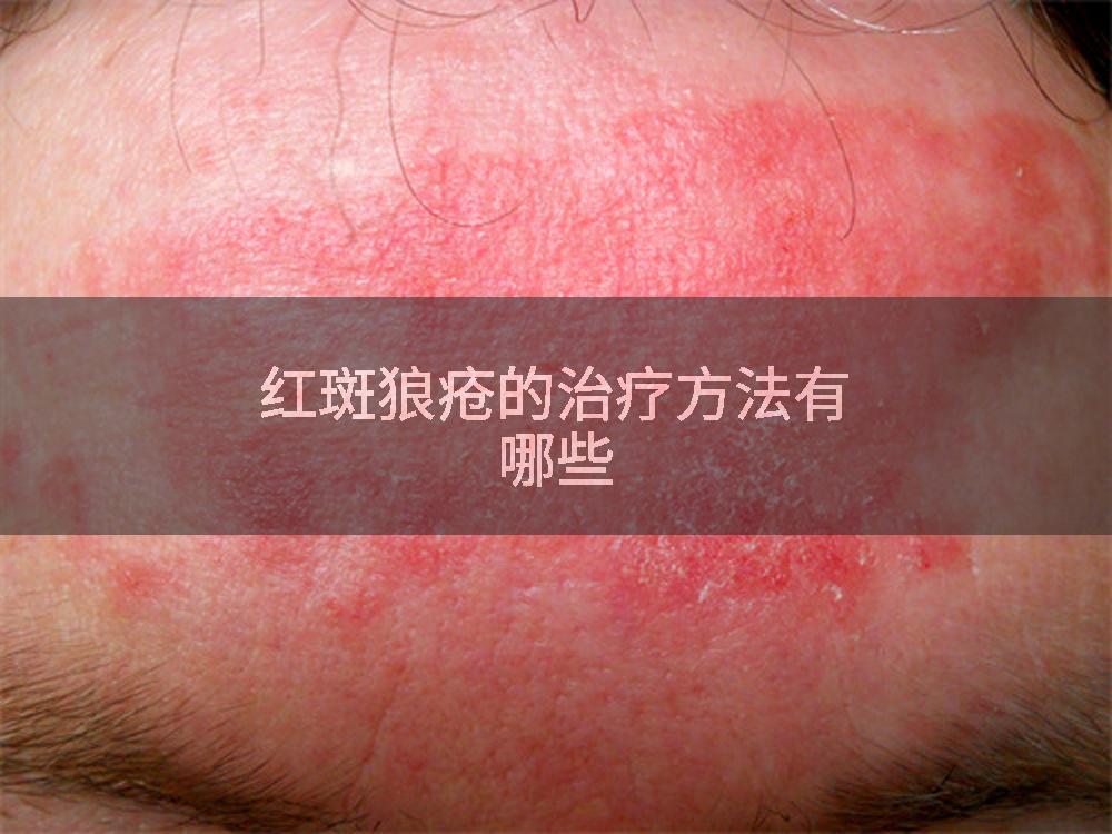 红斑狼疮的治疗方法有哪些