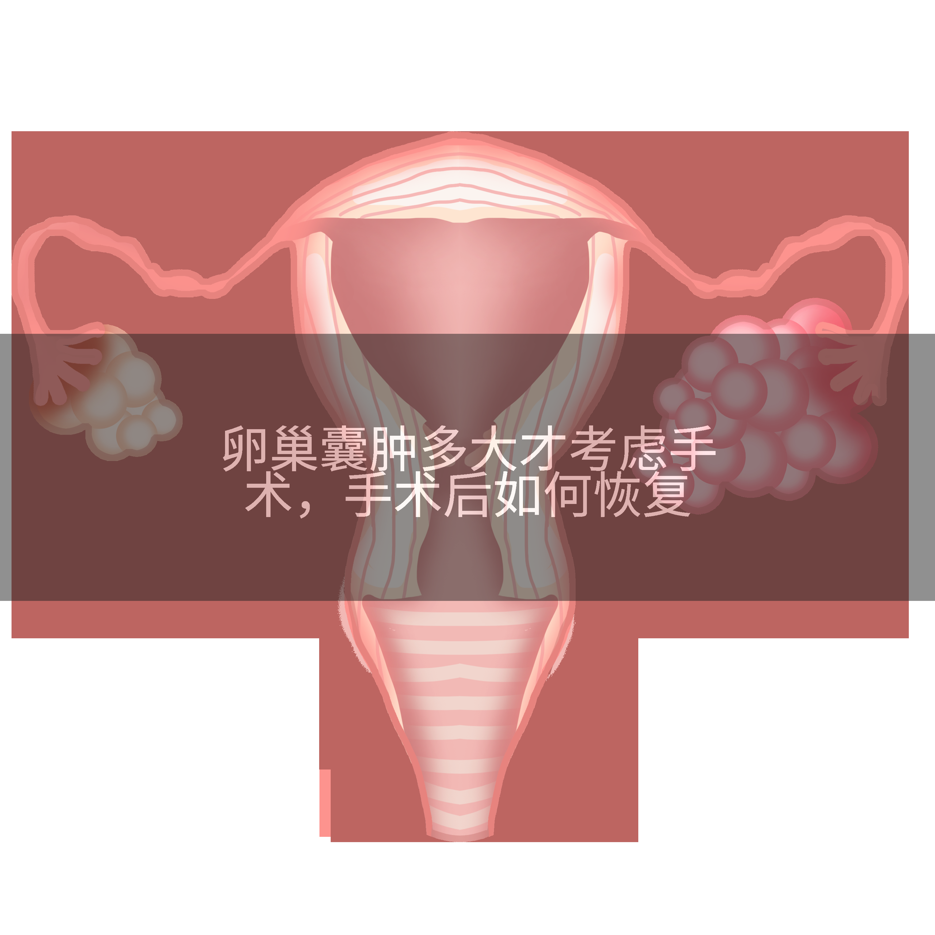 卵巢囊肿多大才考虑手术，手术后如何恢复