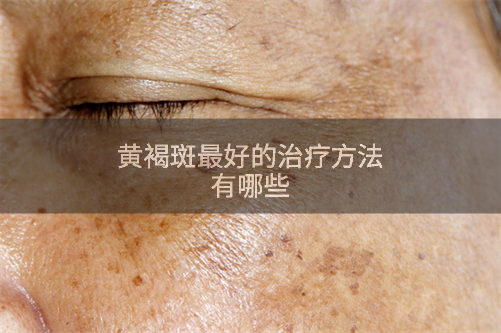 黄褐斑最好的治疗方法有哪些
