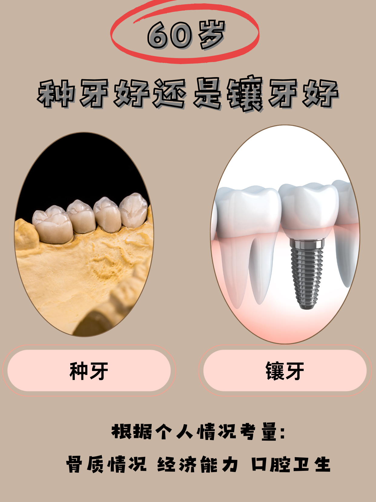 60岁种牙VS镶牙，谁才是晚年幸福的关键？