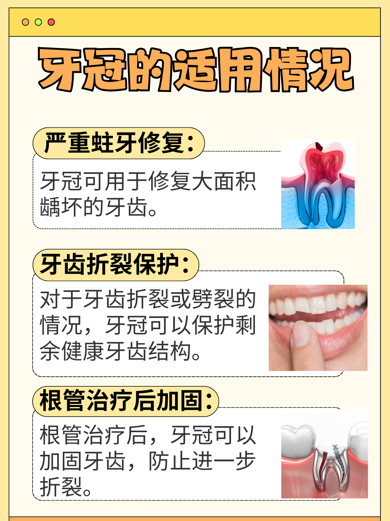 牙冠的秘密：不用去醫院就能搞定的小妙招